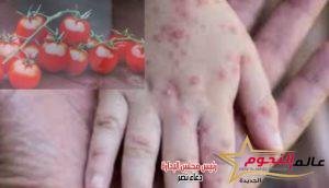 مرض إنفلونزا الطماطم في الهند