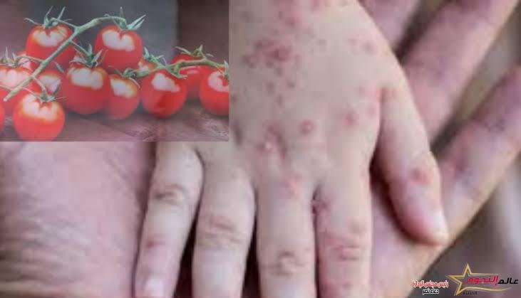 مرض إنفلونزا الطماطم في الهند