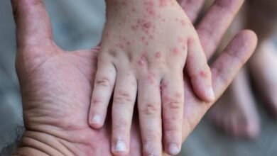 عاجل.. مخاوف صحية في تل أبيب بعد تسجيل إصابة بفيروس الحصبة قادم من لندن