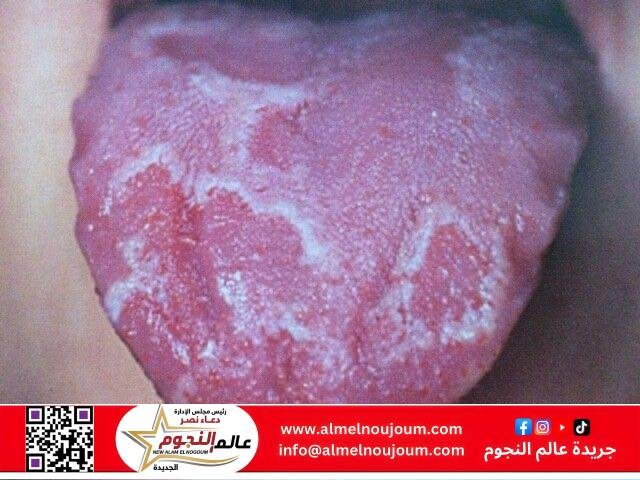 فطريات اللسان.. الأسباب والعلاج والوقاية 4 فطريات اللسان.. الأسباب والعلاج والوقاية