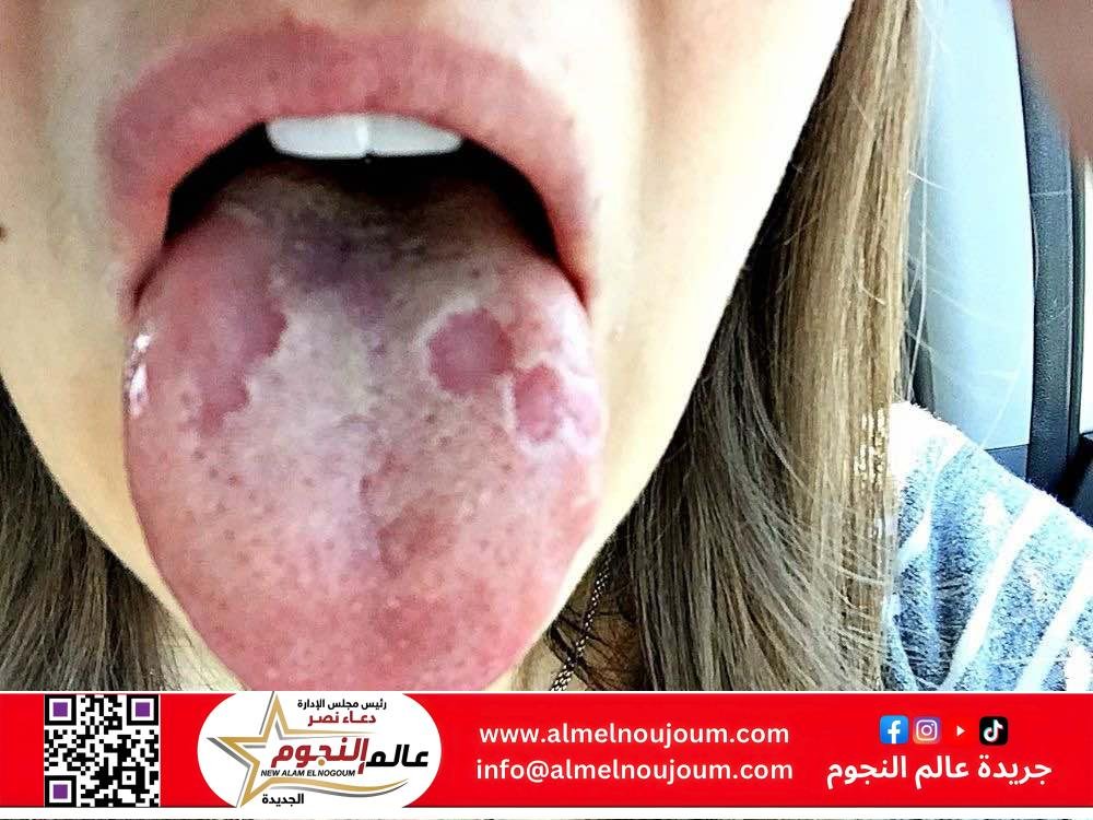 فطريات اللسان.. الأسباب والعلاج والوقاية 3 فطريات اللسان.. الأسباب والعلاج والوقاية