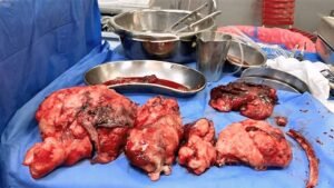 استئصال ورم يزن 9 كجم بنجاح في قصر العيني