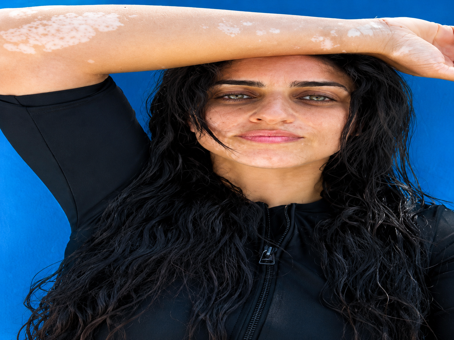أمير كرارة يدعم شقيقته بعد إصابتها بالبهاق.. رسالة مؤثرة تثير تفاعلًا واسعًا
